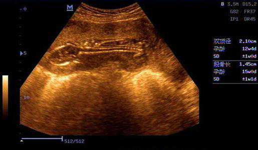 怀孕三个月，看B超单的这些数据，是男是女早知道？